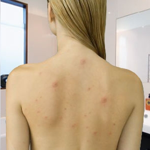 Угревая сыпь на спине: причины и способы их устранения